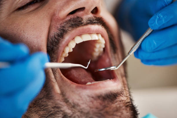 Best Emergency Wisdom Teeth Removal in Durant, OK